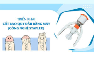 Công Nghệ Surkon Hàn Quốc Cắt Bao Quy Đầu – Quy Trình Và Ưu Điểm