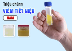 Nguyên Nhân Mắc Tiểu Nhưng Không Tiểu Được
