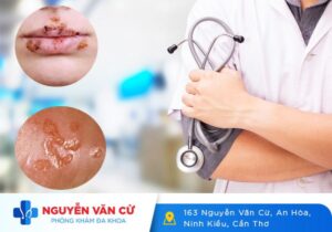 Bệnh Hạ Cam Là Bệnh Gì? Dấu Hiệu Nhận Biết Và Cách Điều Trị