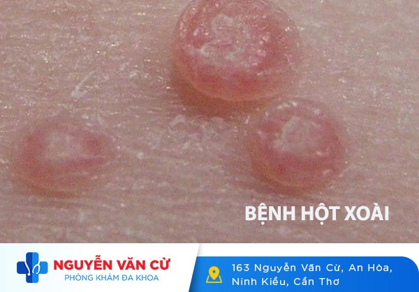 Bệnh Hột Xoài Là Bệnh Gì? Dấu Hiệu Nhận Biết Và Cách Điều Trị