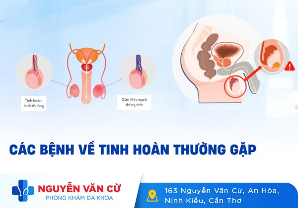 Một Số Bệnh Lý Tinh Hoàn Thường Gặp Ở Nam Giới