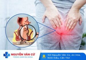 Bệnh Trĩ Là Gì? Dấu Hiệu Nhận Biết Và Cách Chữa Trị Bệnh Trĩ