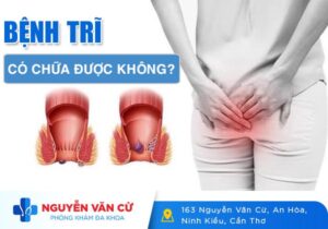Bệnh Trĩ Có Chữa Được Không, Có Dứt Điểm Không?