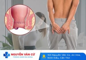 Bệnh Trĩ Ngoại Là Gì? Triệu Chứng Và Cách Chữa Trị Bệnh Trĩ Ngoại