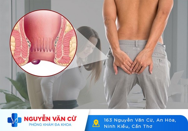 Bệnh Trĩ Ngoại Là Gì? Triệu Chứng Và Cách Chữa Trị Bệnh Trĩ Ngoại
