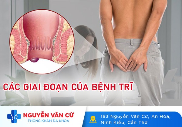 Các Giai Đoạn Của Bệnh Trĩ