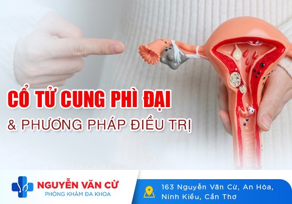 Cổ Tử Cung Phì Đại Và Phương Pháp Điều Trị Hiệu Quả