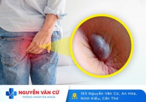 Hậu Môn Lòi Cục Thịt Có Phải Bị Trĩ Không?
