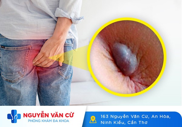 Hậu Môn Lòi Cục Thịt Có Phải Bị Trĩ Không?