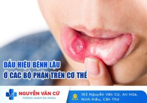 Dấu Hiệu Bệnh Lậu Xuất Hiện Ở Các Bộ Phận Trên Cơ Thể