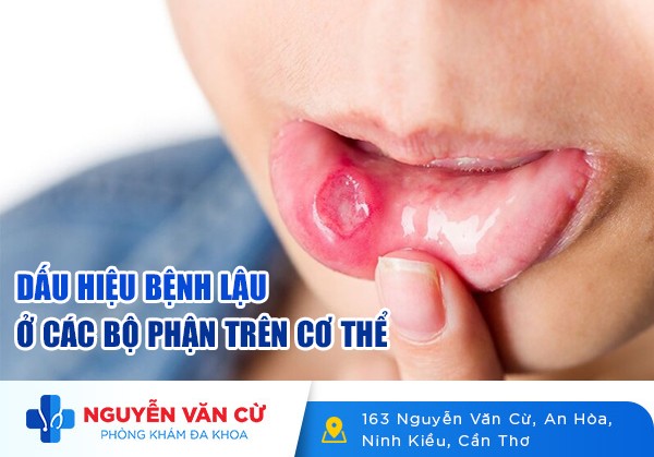 Dấu Hiệu Bệnh Lậu Xuất Hiện Ở Các Bộ Phận Trên Cơ Thể