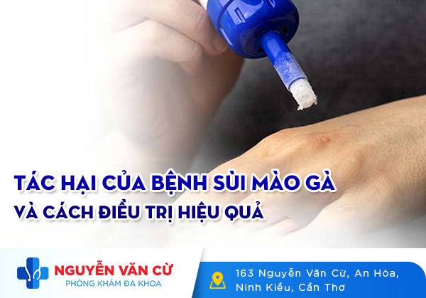 [Cảnh Báo] Những Tác Hại Của Bệnh Sùi Mào Gà Và Cách Điều Trị Hiệu Quả