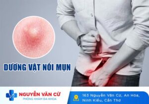 Dương Vật Nổi Mụn Là Dấu Hiệu Của Bệnh Gì?