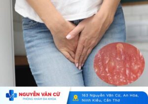 Gai Sinh Dục Là Gì? Dấu Hiệu Nhận Biết Và Cách Điều Trị Bệnh Gai Sinh Dục
