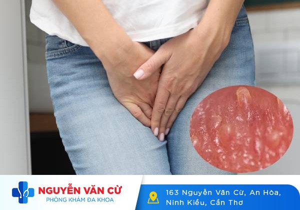 Gai Sinh Dục Là Gì? Dấu Hiệu Nhận Biết Và Cách Điều Trị Bệnh Gai Sinh Dục