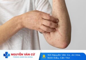 Thời Gian Ủ Bệnh Và Phát Bệnh Giang Mai Là Bao Lâu?