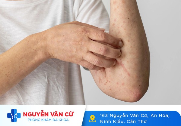Thời Gian Ủ Bệnh Và Phát Bệnh Giang Mai Là Bao Lâu?