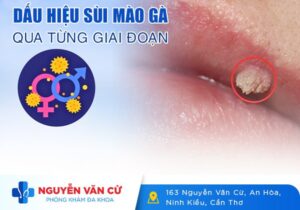 Dấu Hiệu Nhận Biết Triệu Chứng Sùi Mào Gà Qua Từng Giai Đoạn