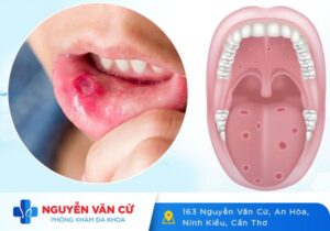 Dấu Hiệu Nhận Biết Giang Mai Ở Miệng Và Cách Điều Trị