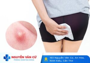 Hậu Môn Nổi Mụn Là Biểu Hiện Bệnh Gì?