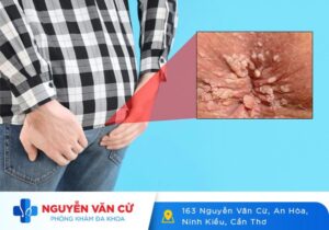 Hậu Môn Nổi Mụn Thịt, Mụn Cóc Là Biểu Hiện Của Bệnh Gì?