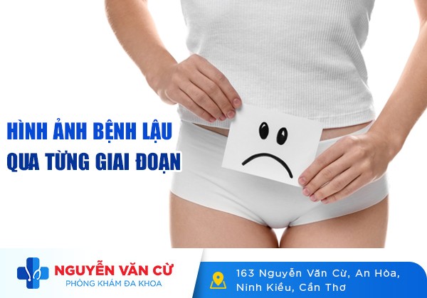 Hình Ảnh Bệnh Lậu Qua Từng Giai Đoạn