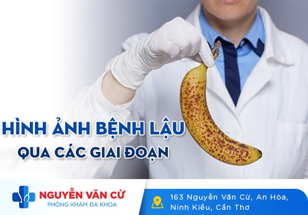 Hình Ảnh Bệnh Lậu Qua Các Giai Đoạn