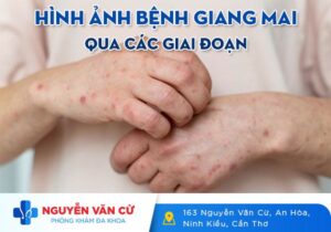 Hình Ảnh Bệnh Giang Mai Qua Các Giai Đoạn