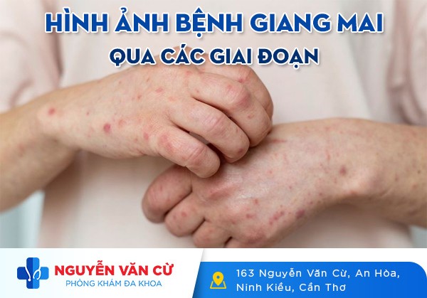 Hình Ảnh Bệnh Giang Mai Qua Các Giai Đoạn