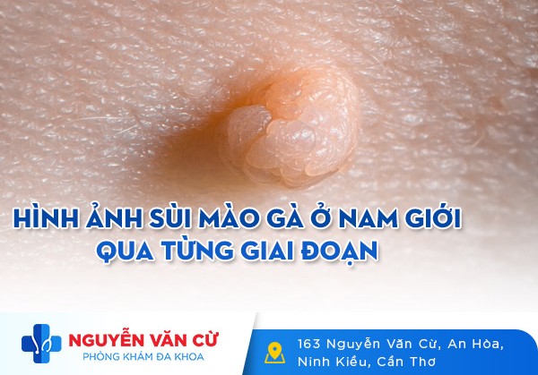 Hình Ảnh Sùi Mào Gà Ở Nam Giới Qua Từng Giai Đoạn