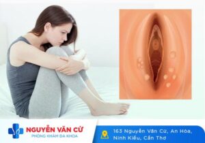 Hình Ảnh Sùi Mào Gà Ở Nữ Giới Qua Từng Giai Đoạn