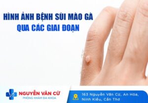 Hình Ảnh Bệnh Sùi Mào Gà Qua Các Giai Đoạn