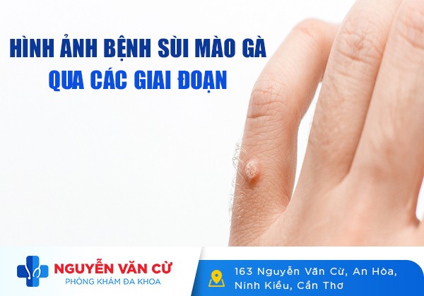 Hình Ảnh Bệnh Sùi Mào Gà Qua Các Giai Đoạn