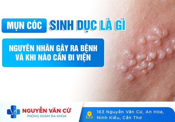 Mụn Cóc Sinh Dục Là Gì Dấu Hiệu Nhận Biết Và Phương Pháp Điều Trị