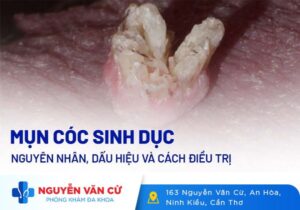 Mụn Cóc Sinh Dục Là Gì Có Nguy Hiểm Không?