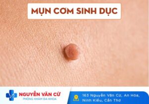 Mụn Cơm Sinh Dục Là Gì Dấu Hiệu Nhận Biết Và Cách Điều Trị