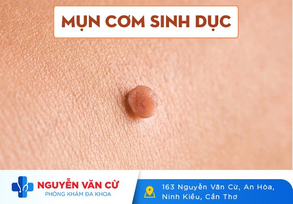 Mụn Cơm Sinh Dục Là Gì Dấu Hiệu Nhận Biết Và Cách Điều Trị