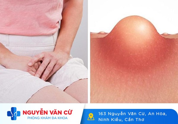 Mụn Nhọt Ở Vùng Kín Nguyên Nhân Và Cách Xử Lý