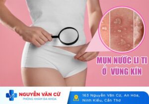 Mụn Nước Li Ti Ở Vùng Kín Nữ