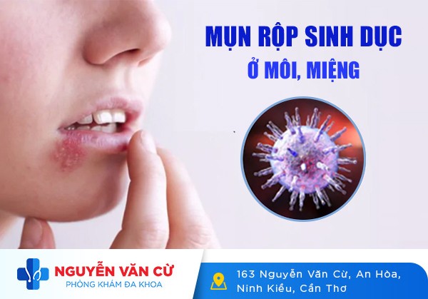 Nổi Mụn Rộp Mụn Nước Ở Môi Có Phải Bị Bệnh Xã Hội Không?