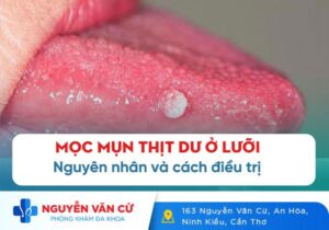 Mụn Thịt Dư Ở Lưỡi Có Phải Là Dấu Hiệu Đã Mắc Bệnh Xã Hội?