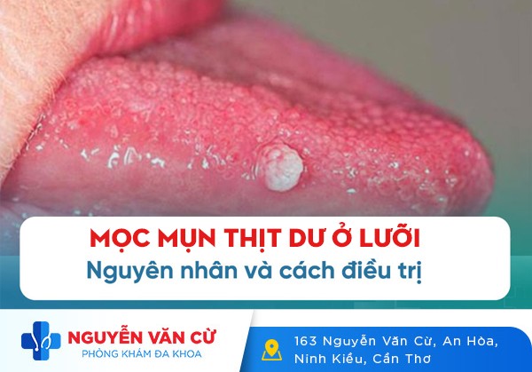 Mụn Thịt Dư Ở Lưỡi Có Phải Là Dấu Hiệu Đã Mắc Bệnh Xã Hội?