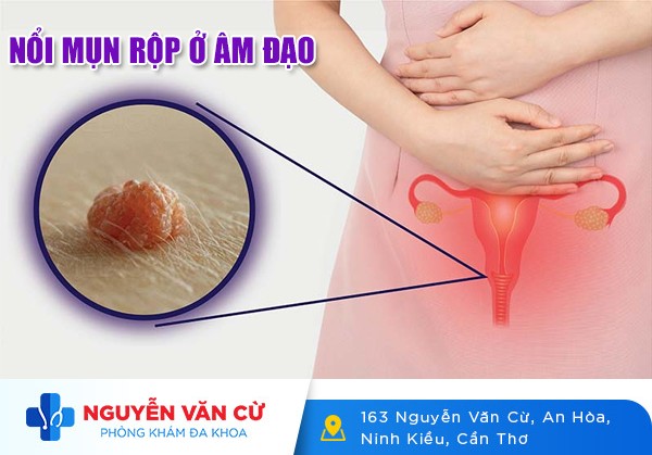 Âm Đạo Nổi Mụn Rộp Ở Phụ Nữ