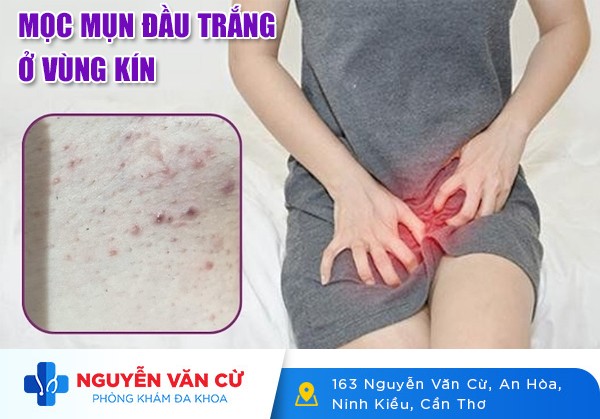 Mọc Mụn Đầu Trắng Ở Vùng Kín