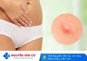 Cách Nhận Biết Biểu Hiện Bị Nổi Mụn Ở Vùng Kín Là Bệnh Gì?