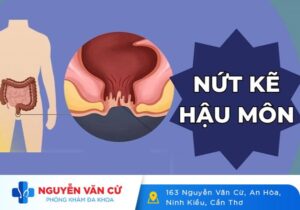 Tại Sao Bị Nứt Kẽ Hậu Môn? Nứt Kẽ Hậu Môn Có Tự Khỏi Không?
