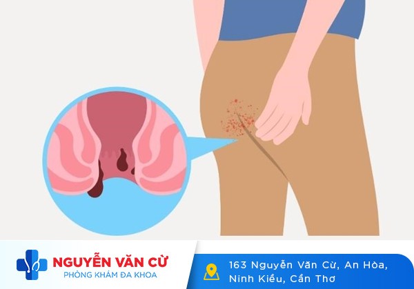 Nứt kẽ Hậu môn Là Dấu hiệu Của Bệnh Gì?
