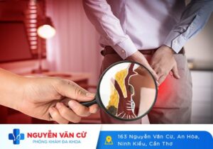 Các Phương Pháp Phẫu Thuật Cắt Mổ Trĩ Tiên Tiến Hiện Nay