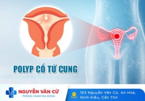 Polyp Cổ Tử Cung Và Những Điều Cần Biết