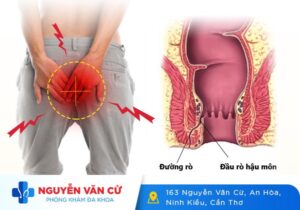 Bệnh Rò Hậu Môn Và Những Điều Cần Biết